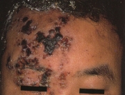 帯状疱疹3.jpg